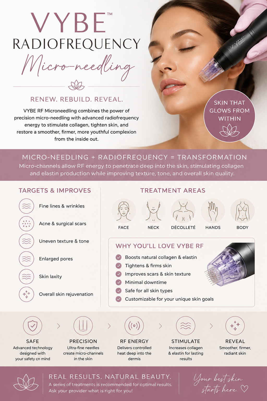 Radio-Frequency VybeRF Microneedling